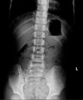 開學學童便秘急診增 醫師：掌握餐後上廁所時機