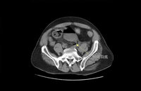 男子便秘三天兩頭自行灌腸　直腸破裂引發腹膜炎
