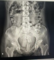 2泰女體內藏115顆海洛英來台　入境遭攔截送辦