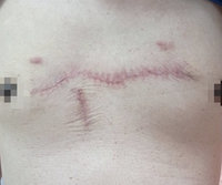 男子胸口青春痘釀蟹足腫　手術使用生物膜明顯改善