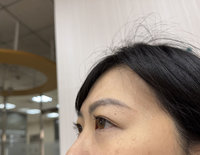 眼皮長黃色瘤別只靠醫美　醫師提醒恐是心血管警訊