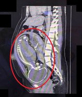 近足月孕婦急性盲腸炎　剖腹併盲腸手術助母嬰平安