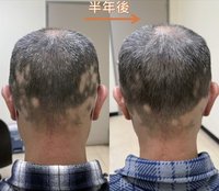 中年男反覆圓形禿　中醫師：恐慢性發炎免疫失衡