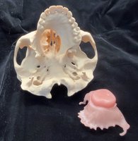 口鼻穿通8年不敢出門　數位閉孔器助再嚐聚餐滋味