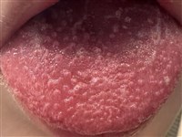 童現草莓舌當心猩紅熱  醫：未治恐併發心臟病