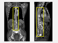 背痛以為脊椎退化 7旬男健檢發現攝護腺癌骨轉移