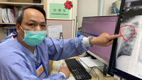 返台畏寒咳嗽診斷肺膿瘍　醫提醒延誤恐致敗血症