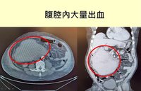 男遭踹一腳險喪命 醫：罕見十二指腸後腹腔大出血