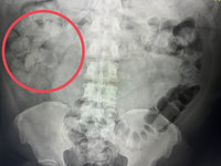 橋檢破獲空中飛人運毒　法男腹藏101顆海洛因膠囊