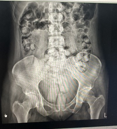2泰女吞藏海洛因小港機場遭攔現形　一審最重判16年