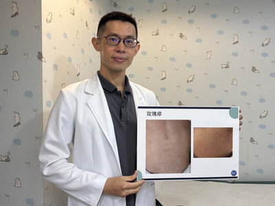 10個月大寶寶高燒4天長紅疹　醫：留意玫瑰疹纏身