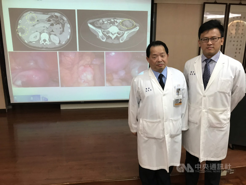 大腸癌轉移至腹膜的狀況是醫師眼中最棘手的難題之一,治療難度高,患者也很難活過1年。馬偕醫院成立「大腸直腸癌腹膜轉移整合治療團隊」,引進腹腔溫熱化療,27日由大腸直腸外科主任劉建國(左)、主治醫師陳建勳(右)進行說明。中央社記者張茗喧攝 108年9月27日