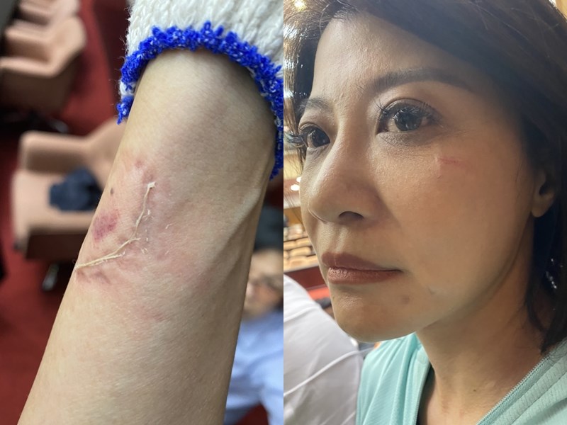 民進黨立委林楚茵手臂遭國民黨立委呂玉玲咬傷,留下明顯的齒痕,臉上也有擦傷。(林楚茵提供)