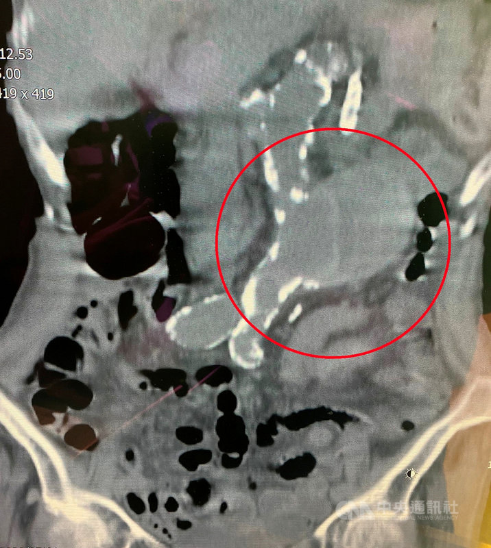 苗栗一名老婦因腹主動脈瘤(紅圈處)破裂併內出血腹痛休克,緊急手術後撿回一命。醫師提醒,腹主動脈瘤平日除了可以從躺著時摸肚子感覺「有一顆球在跳」外,幾乎沒有其他症狀,一旦破裂就可能喪命。(大千綜合醫院提供)中央社記者管瑞平傳真 109年8月3日
