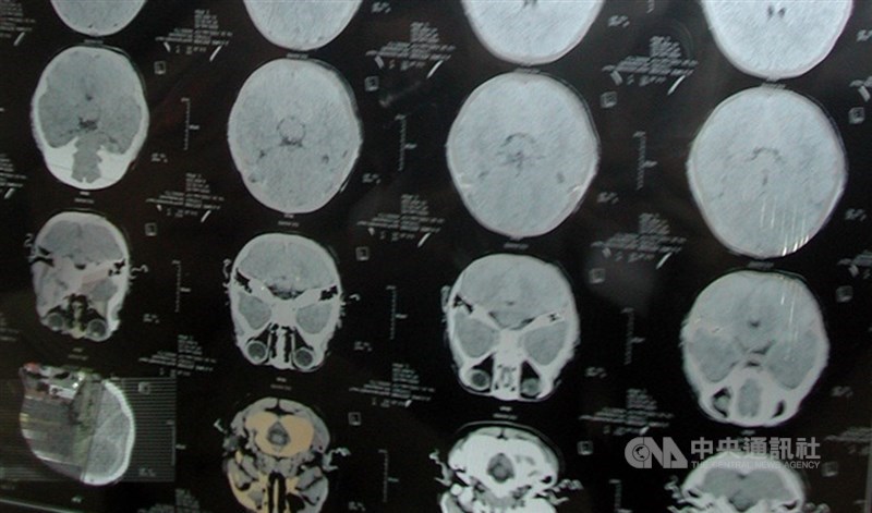 北榮研究團隊找到特有的腦中風突變基因,約1%台灣民眾帶有此基因突變,有此突變者會增加11倍腦部小血管阻塞性中風機會。圖為腦斷層掃瞄影像。(中央社檔案照片)