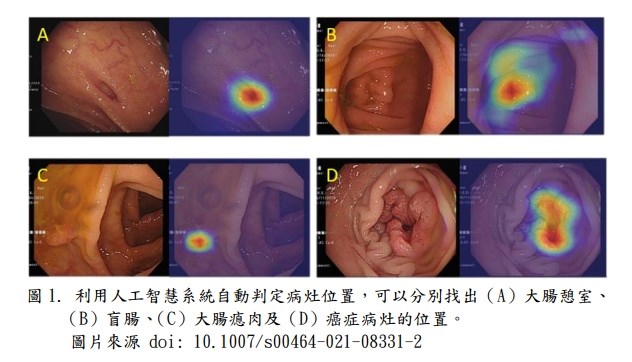 北榮團隊研發出人工智慧輔助診斷系統,可同時辨識息肉、憩室等多種大腸病灶,準確度高達90%。(圖取自台北榮民總醫院網頁vghtpe.gov.tw)