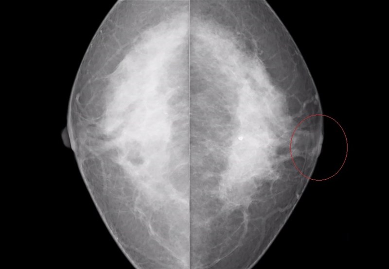 一名63歲婦人左側乳頭凹陷想整形卻發現腫瘤,經醫院切片送驗後發現是原位癌。醫師指出,原位癌難靠觸診發現,且乳頭凹陷成因多,婦女如果出現乳頭凹陷,有異常都應進行切片檢查。圖為婦人左、右側乳房的乳房攝影影像。(彰化醫院提供)中央社記者吳哲豪傳真 110年4月8日