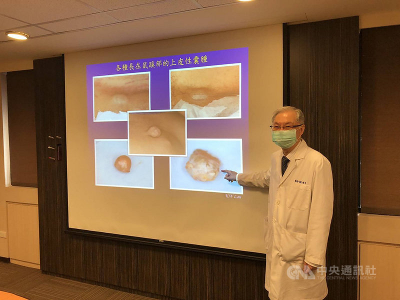 一名男子發現鼠蹊部雙側冒出腫塊,1個月後腫塊表面竟糜爛流出液體且伴隨異味,確診為良性上皮性囊腫發炎。書田診所醫師劉國威(圖)指出,鼠蹊部發現腫塊有30%是惡性腫瘤轉移造成,呼籲提高警覺、及早就醫。(書田診所提供)中央社記者張茗喧傳真 110年4月15日