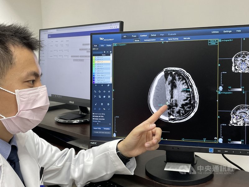 台大醫院4日舉行記者會,宣布與醫隼智慧公司合作研發出全球首款腫瘤自動圈選AI系統VBrain,可自動圈選協助醫師找出微小不易發現的腦癌。 中央社記者江慧珺攝 110年5月4日