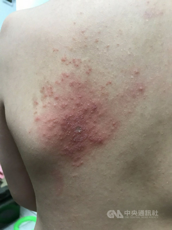 嘉義一名女子近日背部皮膚莫名起水泡、潰爛,醫師發現是她將停在身上的隱翅蟲拍死,隱翅蟲毒液噴到皮膚所致。(大林慈濟醫院提供)中央社記者蔡智明傳真 110年7月26日