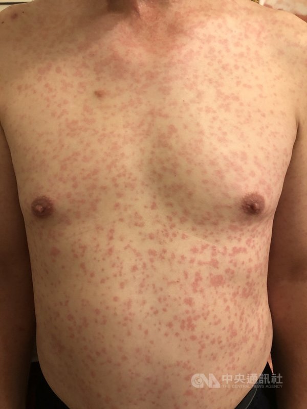 嘉義一名50歲男子接種莫德納疫苗後,在第3天全身出現紅疹,兩度就醫才改善。圖為胸前情況。(許姓男子提供)中央社記者蔡智明傳真 110年7月27日
