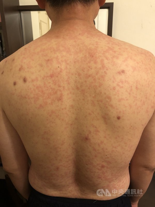 嘉義一名50歲男子接種莫德納疫苗後,在第3天全身出現紅疹,兩度就醫才改善。圖為背部情況。(許姓男子提供)中央社記者蔡智明傳真 110年7月27日