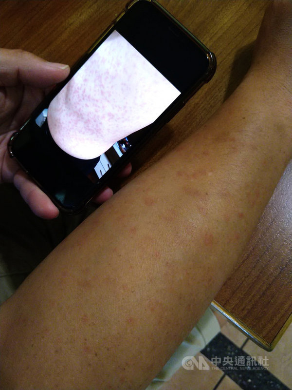 嘉義一名50歲男子接種莫德納疫苗後,在第3天全身出現紅疹(如手機畫面),兩度就醫才改善。對照27日手部皮膚,還可看到紅疹痕跡。中央社記者蔡智明攝 110年7月27日