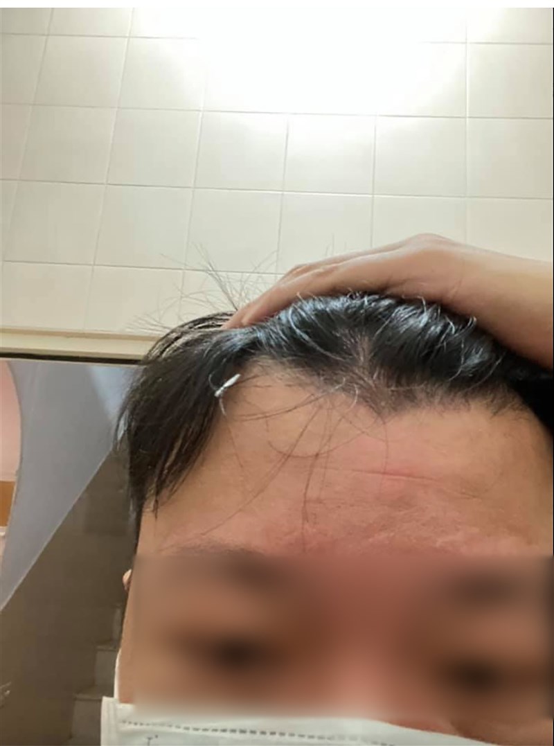 彰化縣一名男子接受針灸治療,結束後回到家發現,額頭處有根針未被拔除。(翻攝照片)中央社記者吳哲豪傳真 110年10月12日