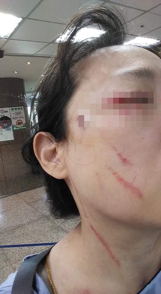 北市一名女子在臉書發文表示,她15日搭電梯時好意提醒女鄰居要戴口罩,不料一出電梯就被對方持刀砍傷。(圖取自爆料公社公開版臉書facebook.com)