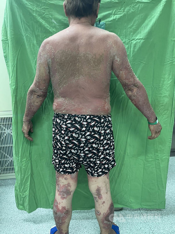 澎湖縣一名70歲男性接種疫苗後,疑發生嚴重不良反應,出現全身性紅疹膿皰脫皮就醫,三總澎湖分院收治個案患者,經醫師診斷及用藥,患者一週後狀況改善恢復健康。(三總澎湖分院提供)中央社 110年10月26日