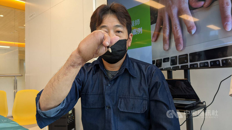 高雄鄭姓男子日前因工安意外導致右手只剩下拇指,1年多後在博田國際醫院在將自己的腳趾移植為手指,鄭男指出,現在的恢復狀況比原本想像中的好很多,也能拿筆寫字,覺得自己非常幸運。中央社記者曾以寧攝 110年11月24日