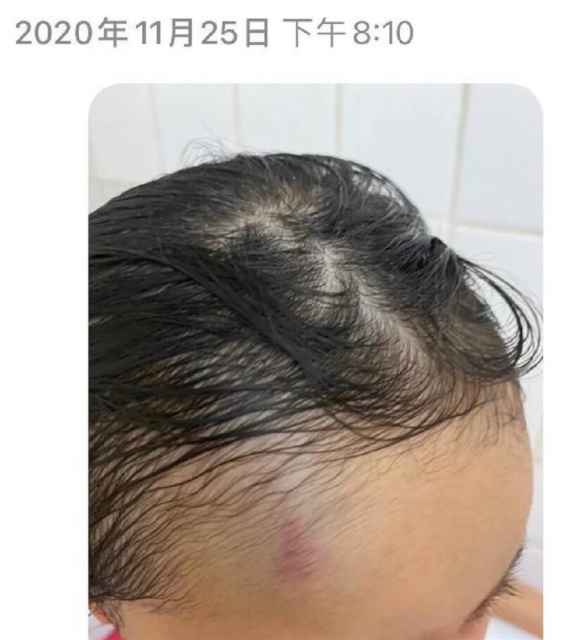 台中有家長爆料知名雙語學校附設幼兒部,只要學童吃飯動作太慢、不午睡等,就遭女教保員拖到廁所暴打,班上逾半數學生都曾遭施暴。圖為幼童額頭出現傷痕。(立委張廖萬堅提供)中央社記者趙麗妍傳真 111年1月27日