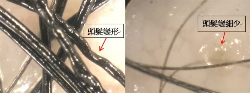 醫師提醒,不當減肥造成短時間體重大量減輕,容易因缺乏維生素H、銅、鐵、鋅、必須脂肪酸和維他命C等毛囊所需營養,引起生長期脫髮。(樂活健康診所提供)中央社記者曾以寧傳真 111年5月26日