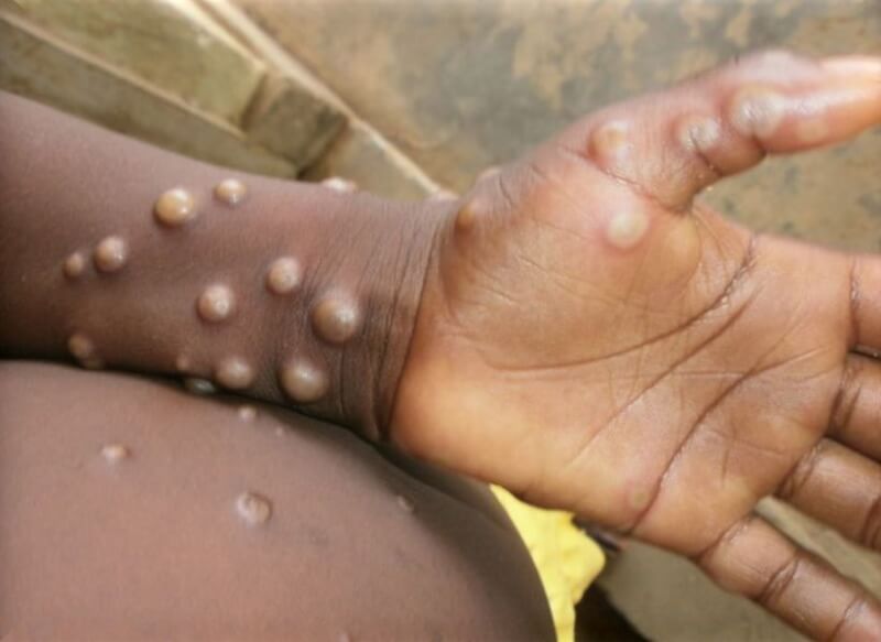 WHO秘書長譚德塞25日說，全球各地爆發的猴痘疫情，尚未構成全球公共衛生緊急事件。（圖取自WHO網頁who.int）