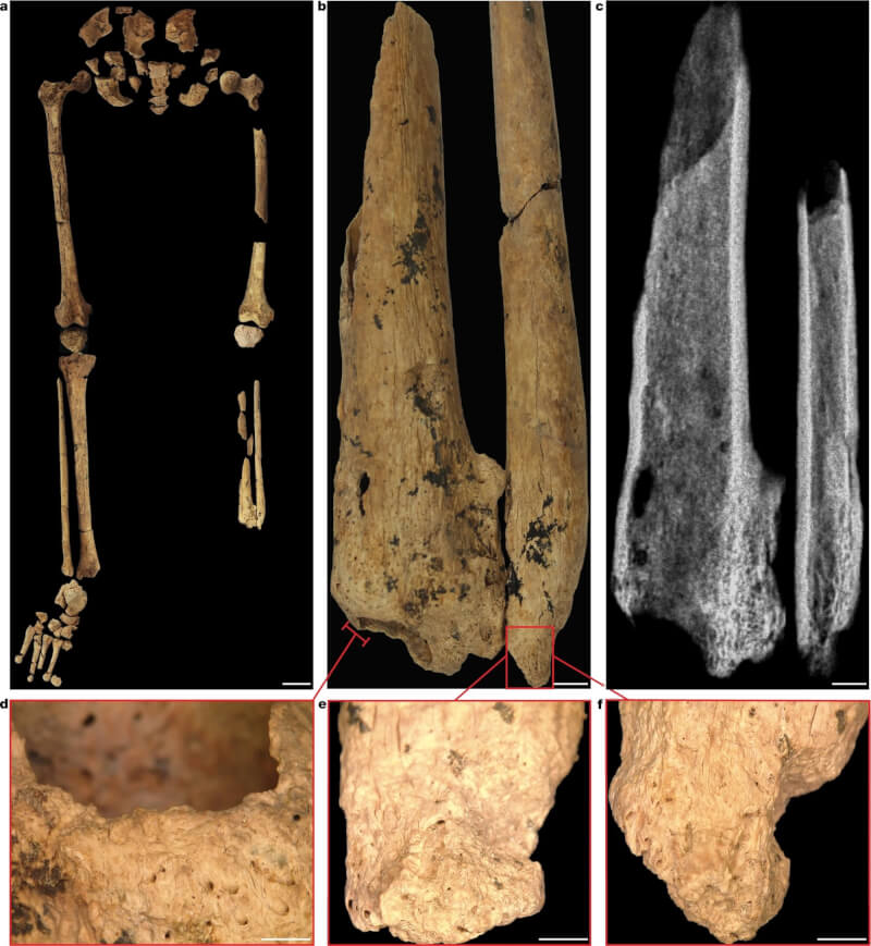 印尼婆羅洲偏遠洞穴中發現一具有3萬1000年歷史、失去左腿下半部的人類骸骨。遺留下來腿骨部分，在乾淨的斷面處長出了骨痂。（圖取自自然期刊網頁nature.com）