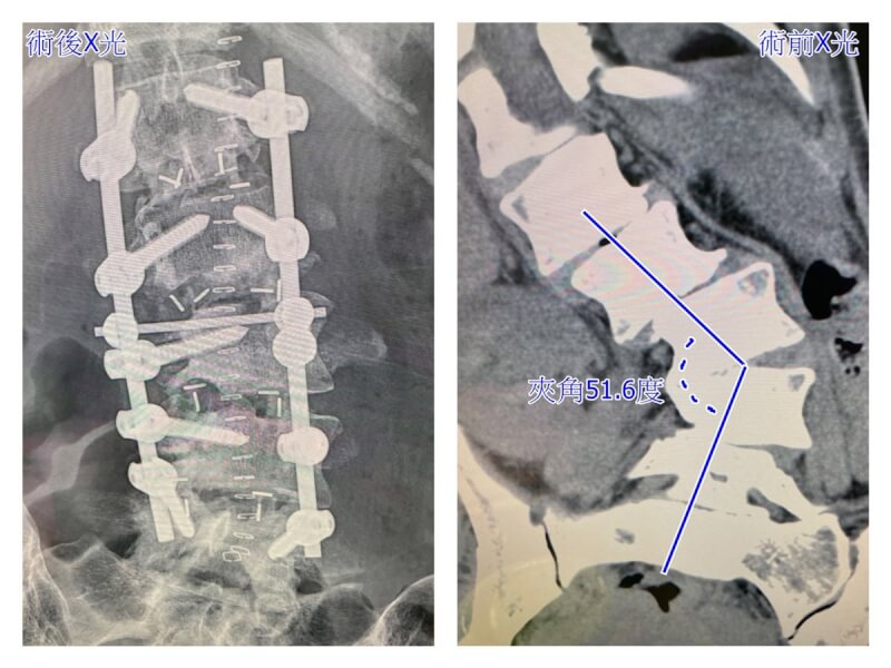 林新醫院發現一名女子因退化性脊柱側彎，脊椎側彎夾角53.3度，形成S狀脊柱合併脊柱扭曲，經手術矯正後，下肢痠麻痛及消化系統症狀明顯改善。（林新醫院提供）中央社記者郝雪卿傳真 111年9月27日