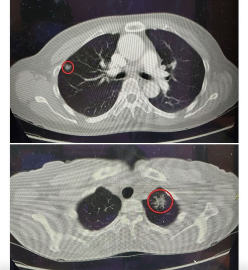 苗栗一名53歲婦人作息正常、不抽菸也鮮少下廚，因配合公司體檢，去年底進行低劑量肺部電腦斷層檢查時發現右側肺腺癌，追蹤半年後又發現左側肺腺癌，所幸因發現得早，婦人經2次手術治療後恢復良好。（大千醫院提供）中央社記者管瑞平傳真 111年9月29日