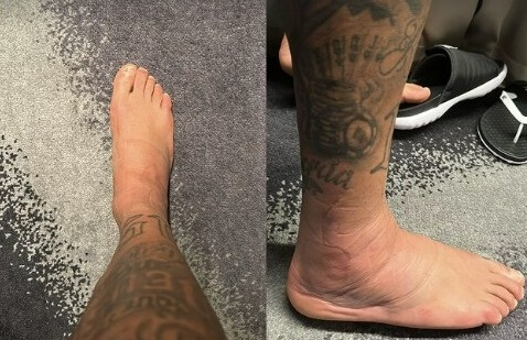 巴西球星內馬爾在Instagram限時動態上分享腳踝傷勢的照片。（圖取自instagram.com/neymarjr/）