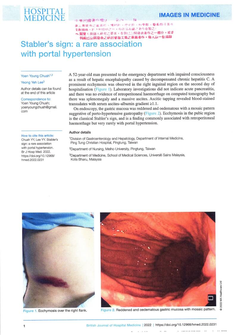52歲男性身上出現新生兒身上常見的腹股溝瘀青，為全球文獻首例，屏東基督教醫院發現後，在馬來西亞理科大學醫學院教授李永葉協助下將案例寫成論文，投稿英國醫院醫學雜誌（British Journal of Hospital Medicine），今年10月通過審核刊登。（屏東基督教醫院提供）中央社記者李卉婷傳真 111年12月22日