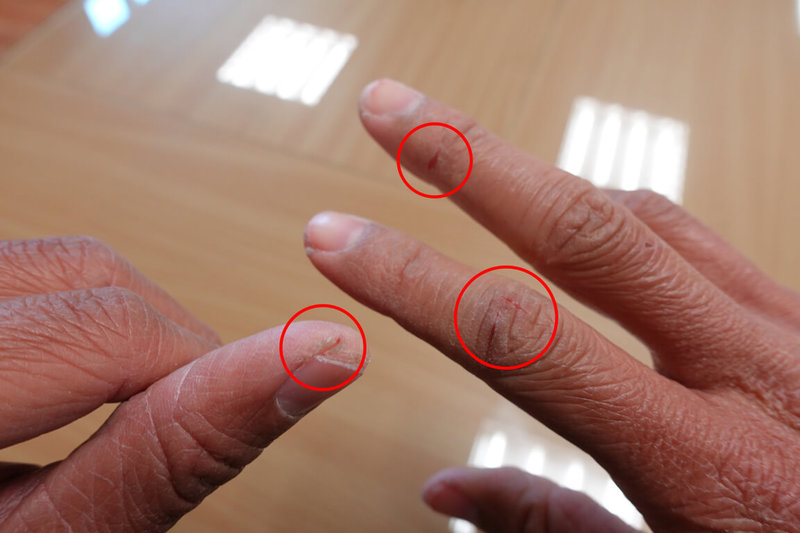 冬季季節天氣較為乾燥，許多皮膚乾燥的人在雙手指節、腳跟處出現裂痕，醫師呼籲做好皮膚保濕。（台中慈濟醫院提供）中央社記者趙麗妍傳真  112年2月13日