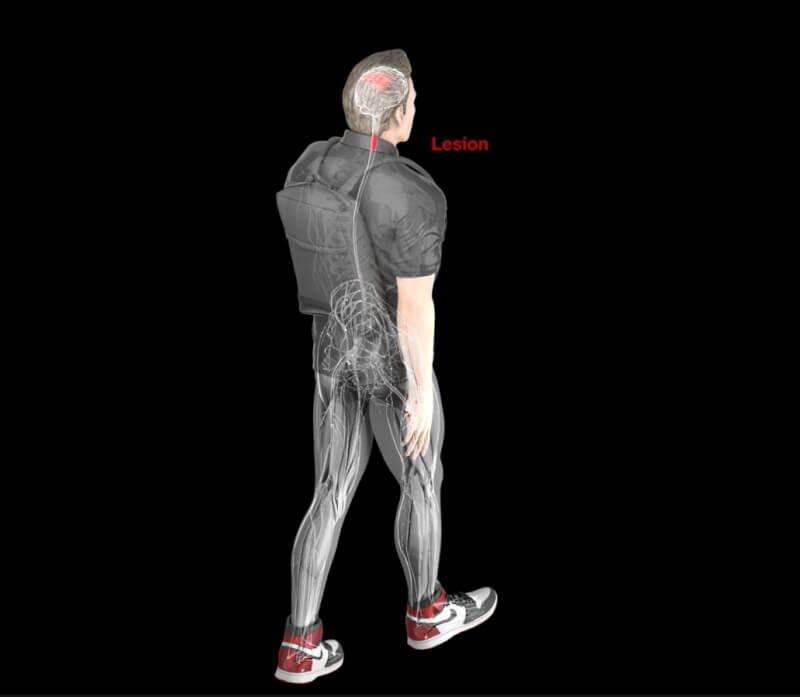 这项新技术是将脑机介面植入大脑控制腿部动作区域的上方（脑部红色区块），解算病患意念后，再透过可携式装置，将资料传至脊髓植入物（下方红色区块），病患即可靠著意念控制行走。（图取自洛桑联邦理工学院网页actu.epfl.ch）
