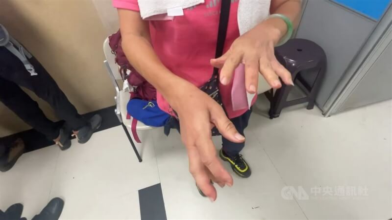 新北市瑞芳山區20日發生多名登山客遭蜂螫事件,被送往基隆長庚醫院的傷者秀出遭蜜蜂螫傷的手部,指出傷處麻痛難耐。中央社記者王朝鈺基隆攝 112年9月20日