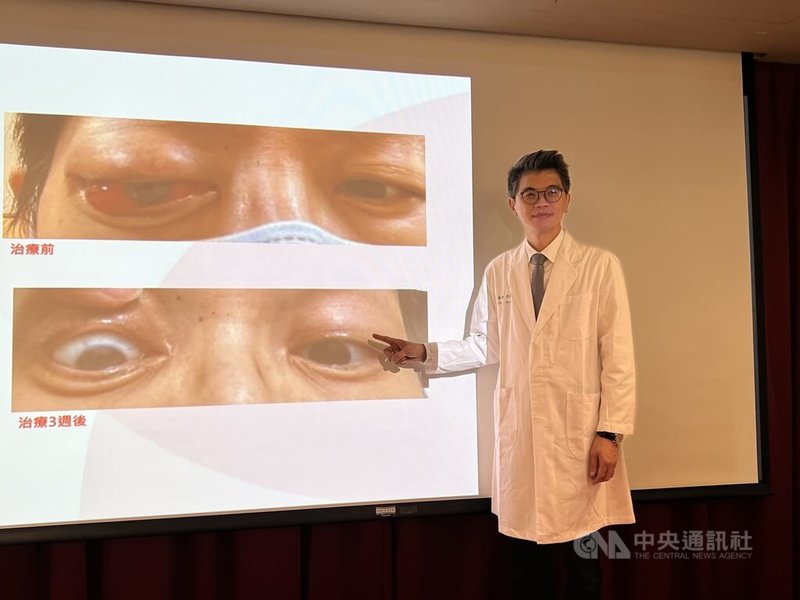 中國醫藥大學附設醫院乳房外科主任劉良智（圖）6日在記者會中表示，有名女子罹患乳癌後，癌細胞罕見轉移到眼窩，造成眼球外凸，多名眼科醫師建議摘除眼球保命，但患者在接受抗體藥物複合體（ADC）治療3週後獲改善。中央社記者郝雪卿攝  112年10月6日
