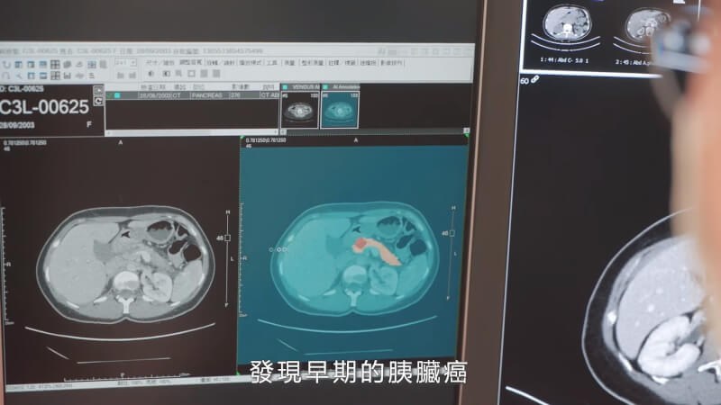圖為醫師使用AI輔助工具，藍色區塊為AI判讀電腦斷層後的結果，橘色區域為胰臟，紅色區塊疑似為腫瘤。（圖取自MeDA Lab網頁medalab.ai）
