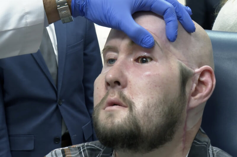 46歲工人詹姆斯（圖）5月接受全球首例全眼球移植手術。（美聯社）