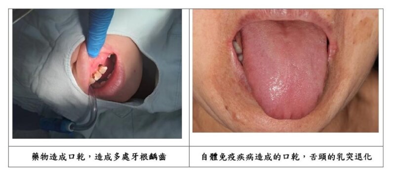 醫師提醒，口乾會造成口水變少、變濃稠，除與喝水量有關，也可能是疾病或藥物引起，不僅會讓嘴破癒合變慢，還會增加蛀牙、感染風險。（台北榮總提供）中央社記者曾以寧傳真 113年8月22日