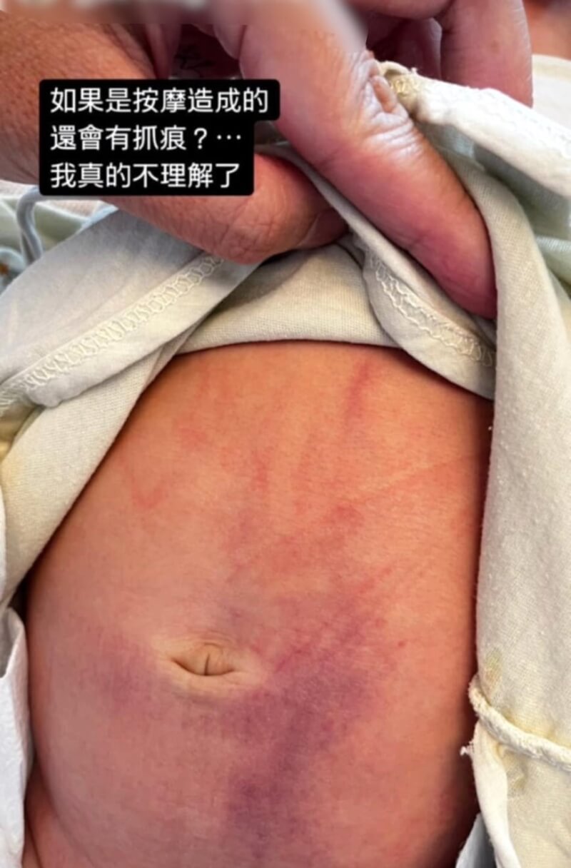 嘉義縣大林鎮某產後護理之家發生滿月男嬰疑遭受虐，造成腹部瘀青情況，目前在加護病房觀察，家屬向警方報案。（民眾提供）中央社記者黃國芳傳真 113年10月7日