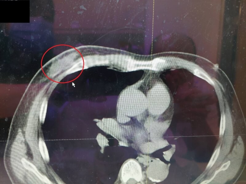 苗栗縣62歲王姓男子因右側乳頭連續數月有出血症狀,前往醫院求診,竟是不常見的男性乳癌,所幸經安排乳房根除手術,持續以藥物治療已獲控制。(大千綜合醫院提供)中央社記者管瑞平傳真 113年11月6日