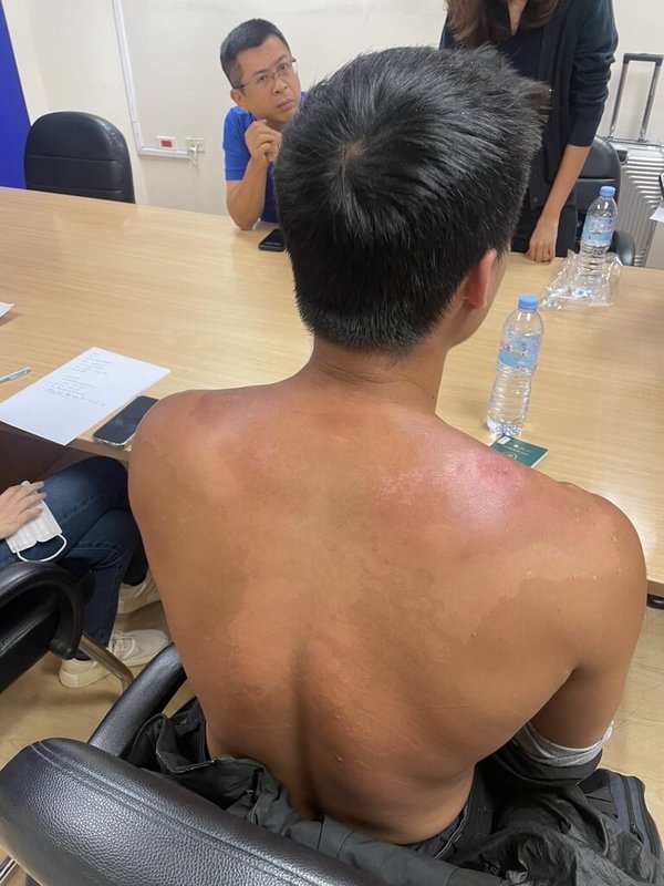 台灣火舞表演者謝岳鵬遭騙到緬甸詐騙園區,在台泰警方合作下14日安全搭機返台。圖為謝岳鵬在詐騙園區被懲罰曝曬後的傷口。(泰國警方提供)中央社記者呂欣憓曼谷傳真 114年1月14日