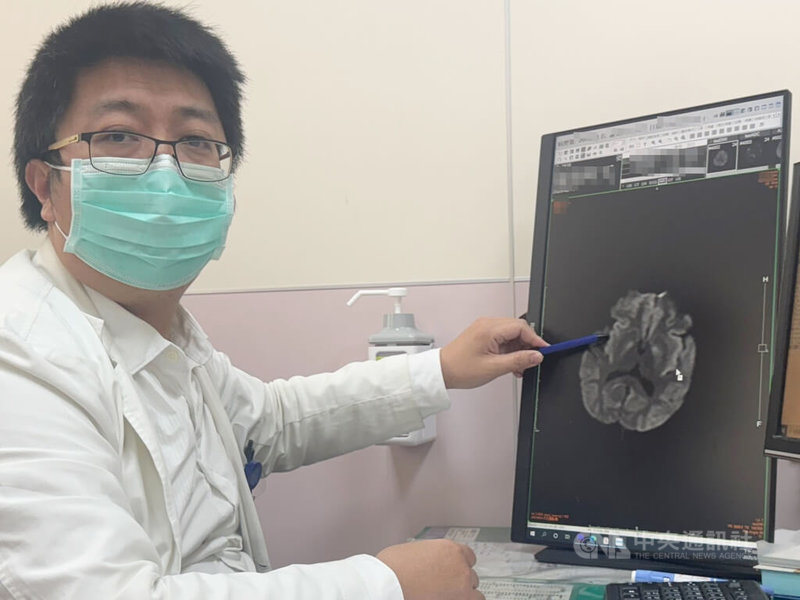 台中大甲李綜合醫院神經內科醫師張峻誠(圖)指出,1名患者因低血糖過久造成腦皮質腫脹。中央社記者趙麗妍攝 114年3月14日
